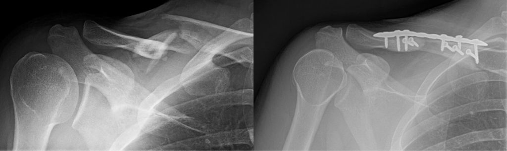 clavicle fractures 20